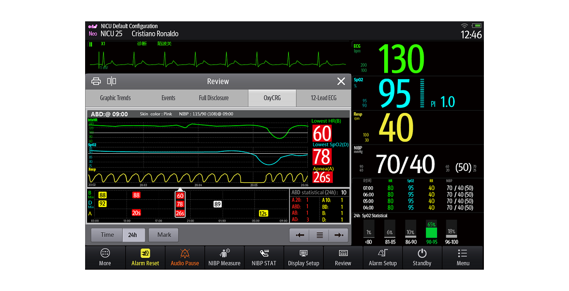 Monitorowanie i analiza epizodów bezdechu, bradykardii i desaturacji (ABD) w monitorach pacjenta BeneVision serii N oraz ePM